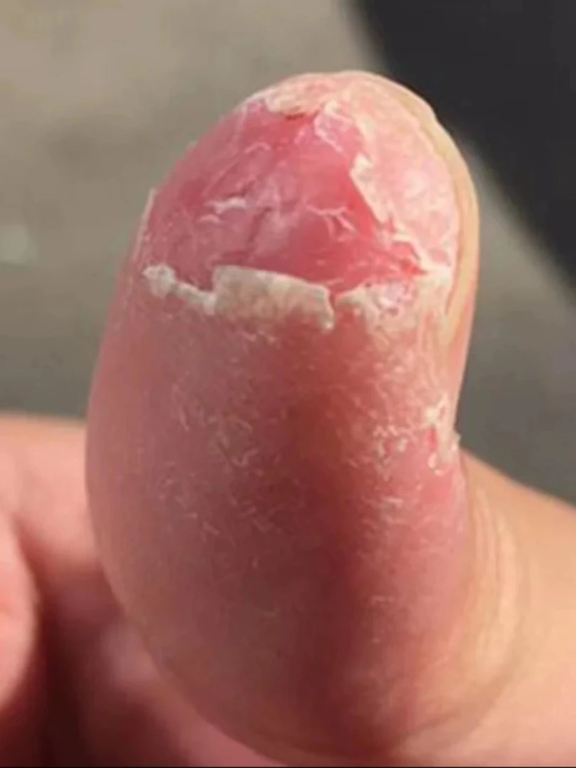 手指脱皮裂口干裂粗糙手指头开裂干裂脱皮指尖裂口修复手裂愈合灵