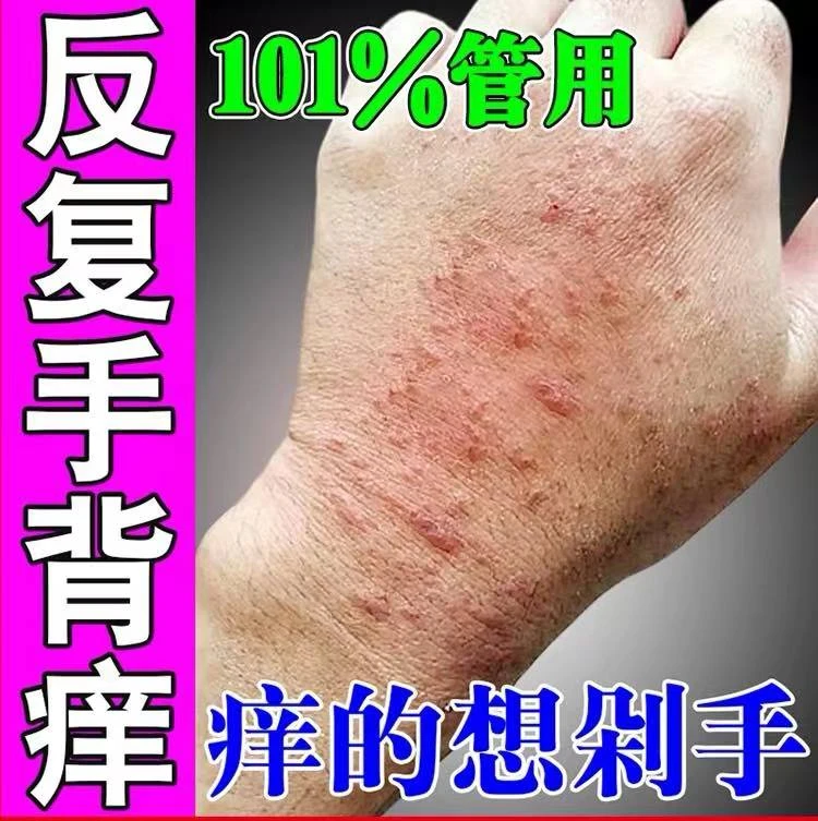 手背痒手上起小水泡长小疙瘩痒季节性手背痒反复痒抑菌止痒软膏