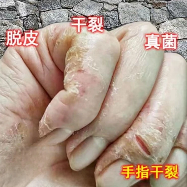 严重手足干裂脱皮脚后跟干裂皲裂脚裂膏止痒防冻裂膏防干裂护手霜