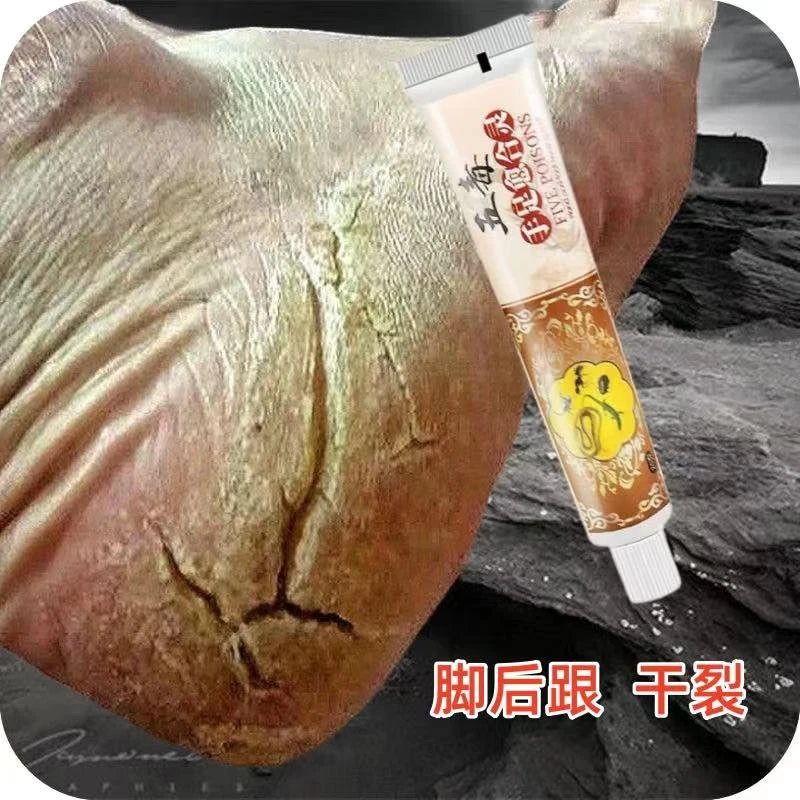 脚后跟严重干裂裂口足底老茧硬皮老化角质化粗糙干燥脱皮干裂软膏