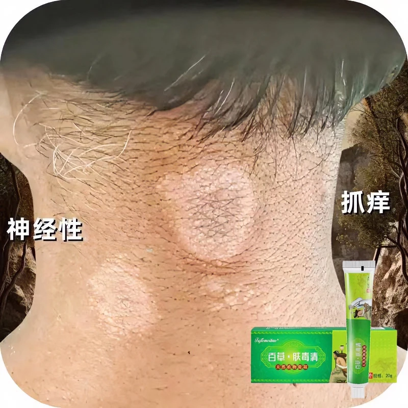 神经性皮肤痒红痒发红刺挠起皮颈部痒干痒脖子后痒强效止痒软膏