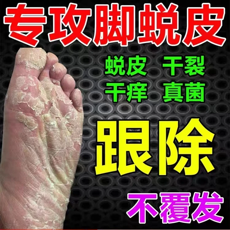 脚底脱皮小水泡脚痒型干裂去死皮脚脱皮烂脚趾缝严重脚脱皮脚康王