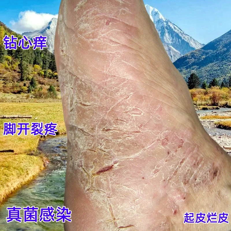 脚底干裂起皮脚痒护理膏脚部干痒脱皮裂口抑菌止痒草本膏