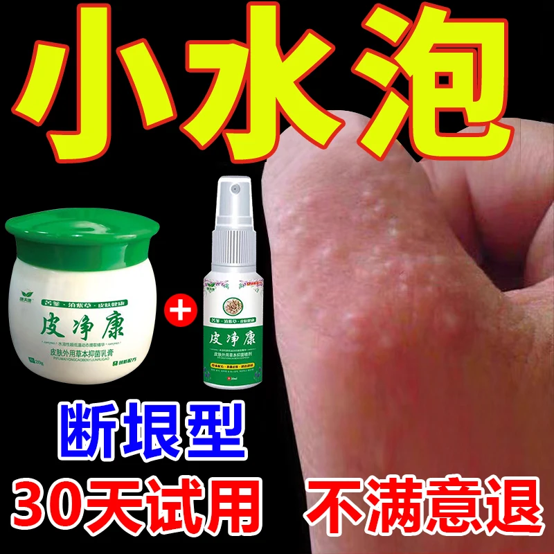 手上起小水泡止痒膏脱皮抑菌克星手指缝痒干裂汗专珍用泡特效喷剂