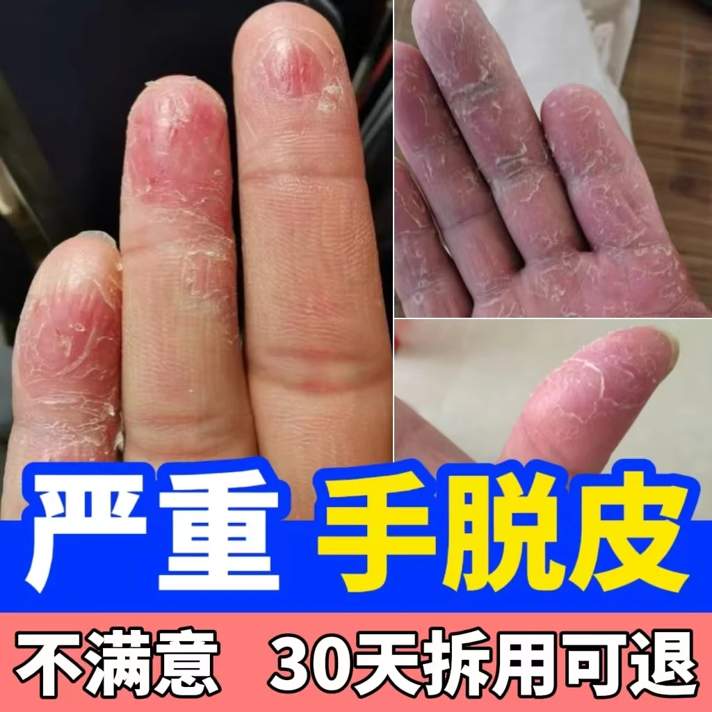 手指头脱皮起干皮手干裂手掌心脱皮起硬皮手足脱皮变硬外用涂抹膏