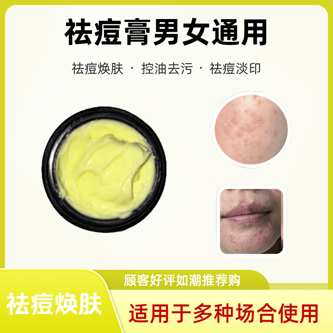 主播自用同款祛痘膏莳康草本痘痘粉刺外用膏草本男女通用