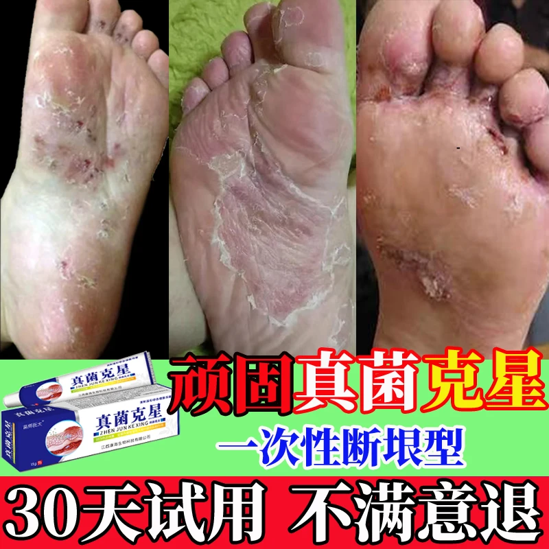 真菌王止痒膏真菌克星抑菌感染去脚臭脱皮干裂趾缝烂痒专用正品