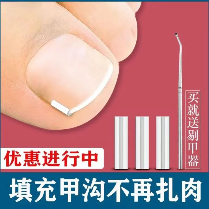 甲沟炎矫正神器指甲扎肉矫正垫片大脚趾甲往肉里长嵌甲矫正专用