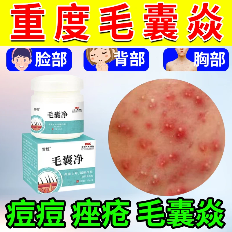 头上红痘痘干痒起皮泛红疙瘩毛囊堵塞红肿毛囊清膏专用