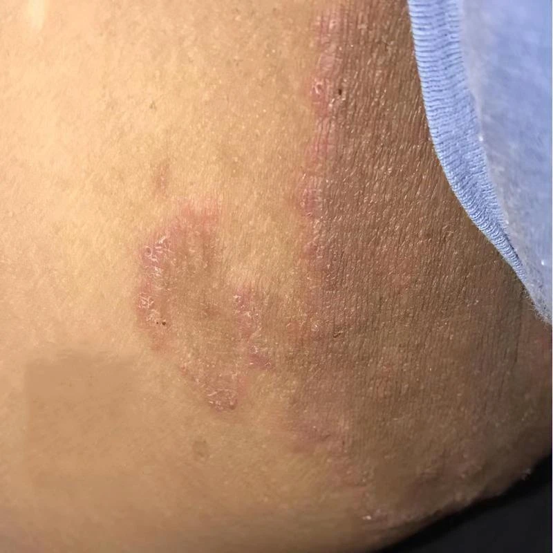 大腿两侧发黑内侧大腿痒发红疼痛磨大腿根部疙瘩乳膏抑菌止痒膏