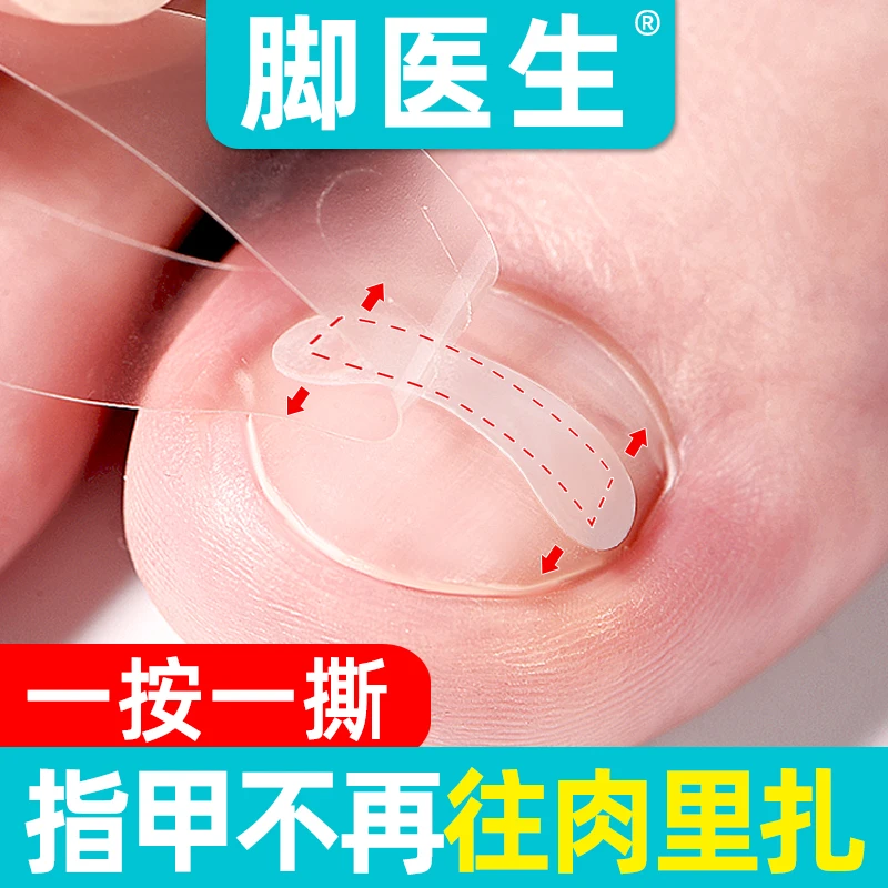 DR.JYS脚医生正甲贴嵌甲纠正器脚趾指甲长肉里记忆型