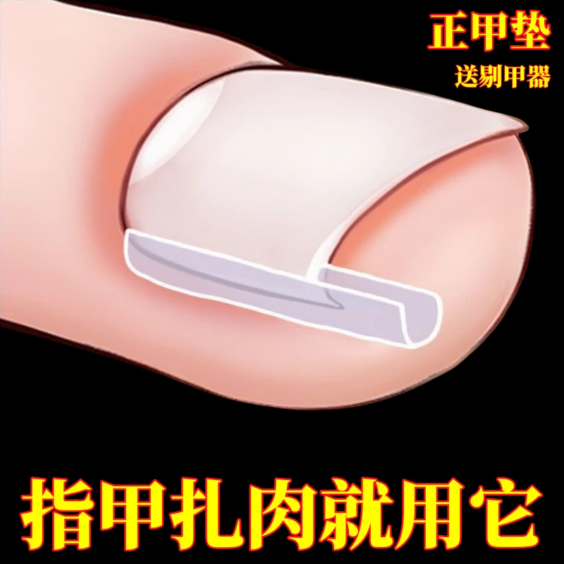 甲沟炎矫正神器家用指甲填充垫学生嵌甲扎肉脚趾甲长肉里正甲工具