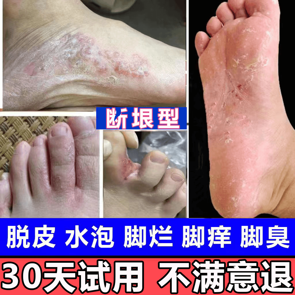 脚痒脚臭止痒膏去脚出汗脱皮起水泡干裂脚趾缝痒喷剂抑菌止痒神器