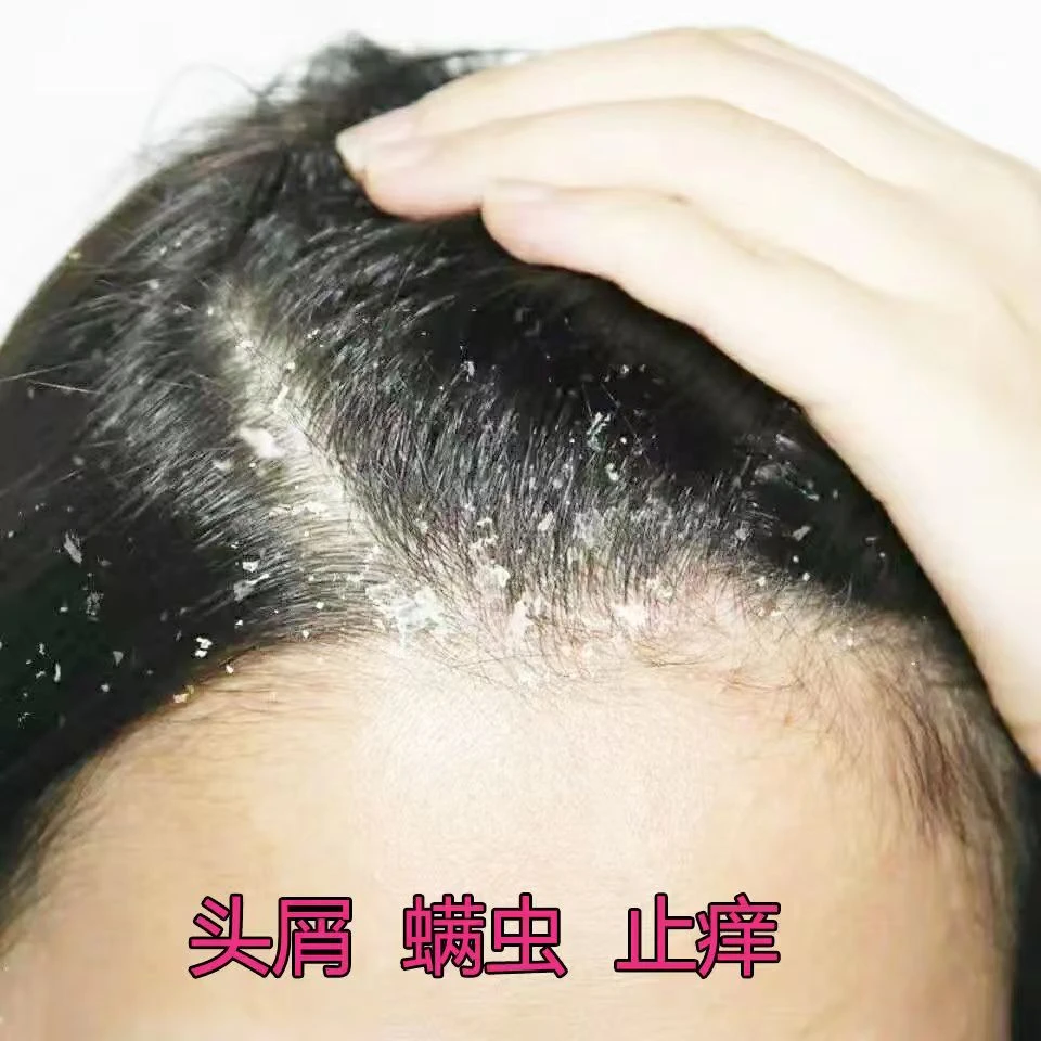 屑康王去屑洗发水强力去屑止痒二硫化硒控油除大块头皮屑抑菌护发