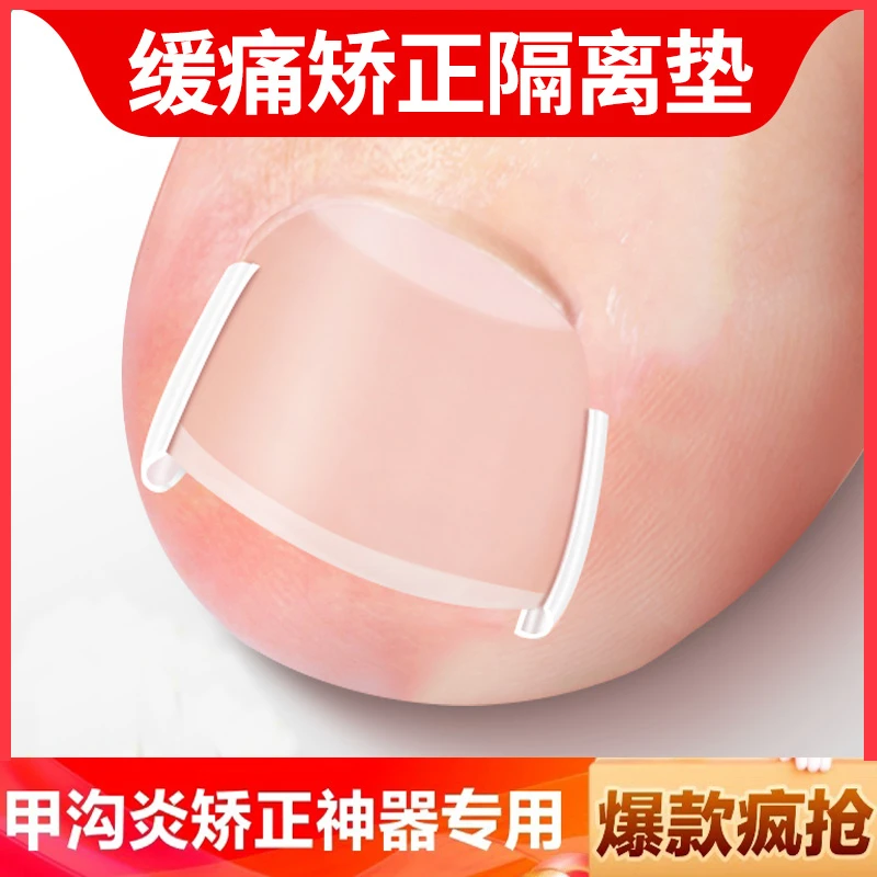 甲沟炎矫正神器嵌甲矫正器指甲扎肉脚趾甲长肉了专用纠正隔离垫片