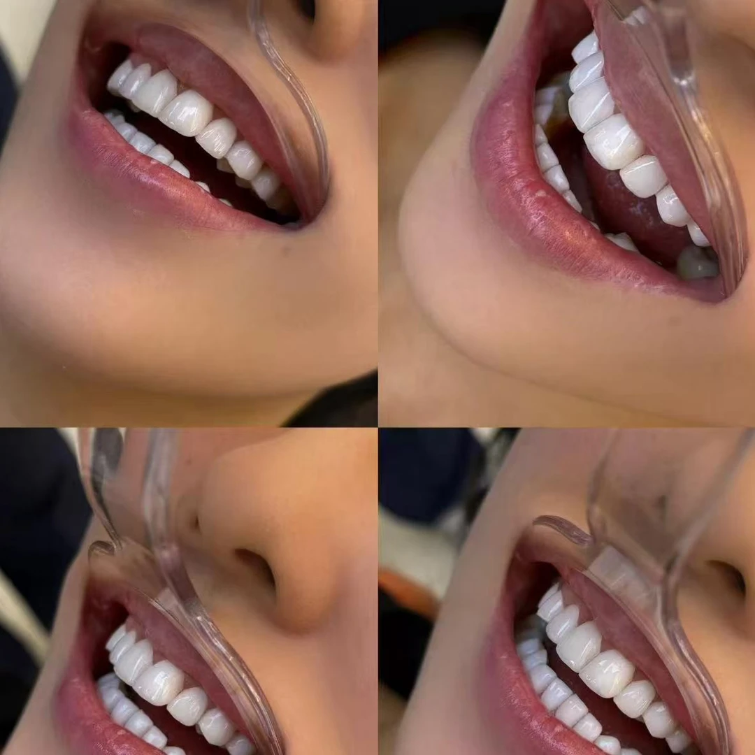 炫白牙贴炫白牙贴