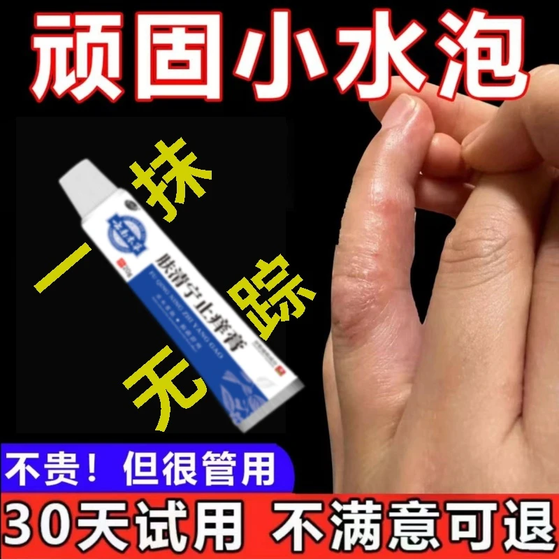 手指上很痒起小水泡止痒膏汗珍泡脱皮干裂克星抑菌专用特效