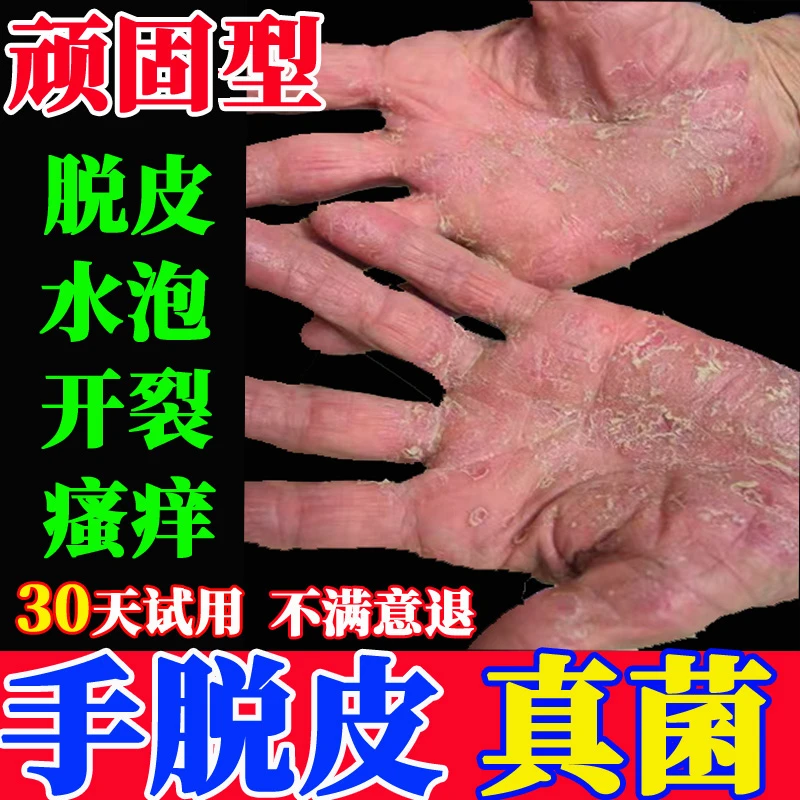 真菌王手足脱皮干燥痒手掌手指小水泡止痒膏真菌克星抑菌正品喷剂