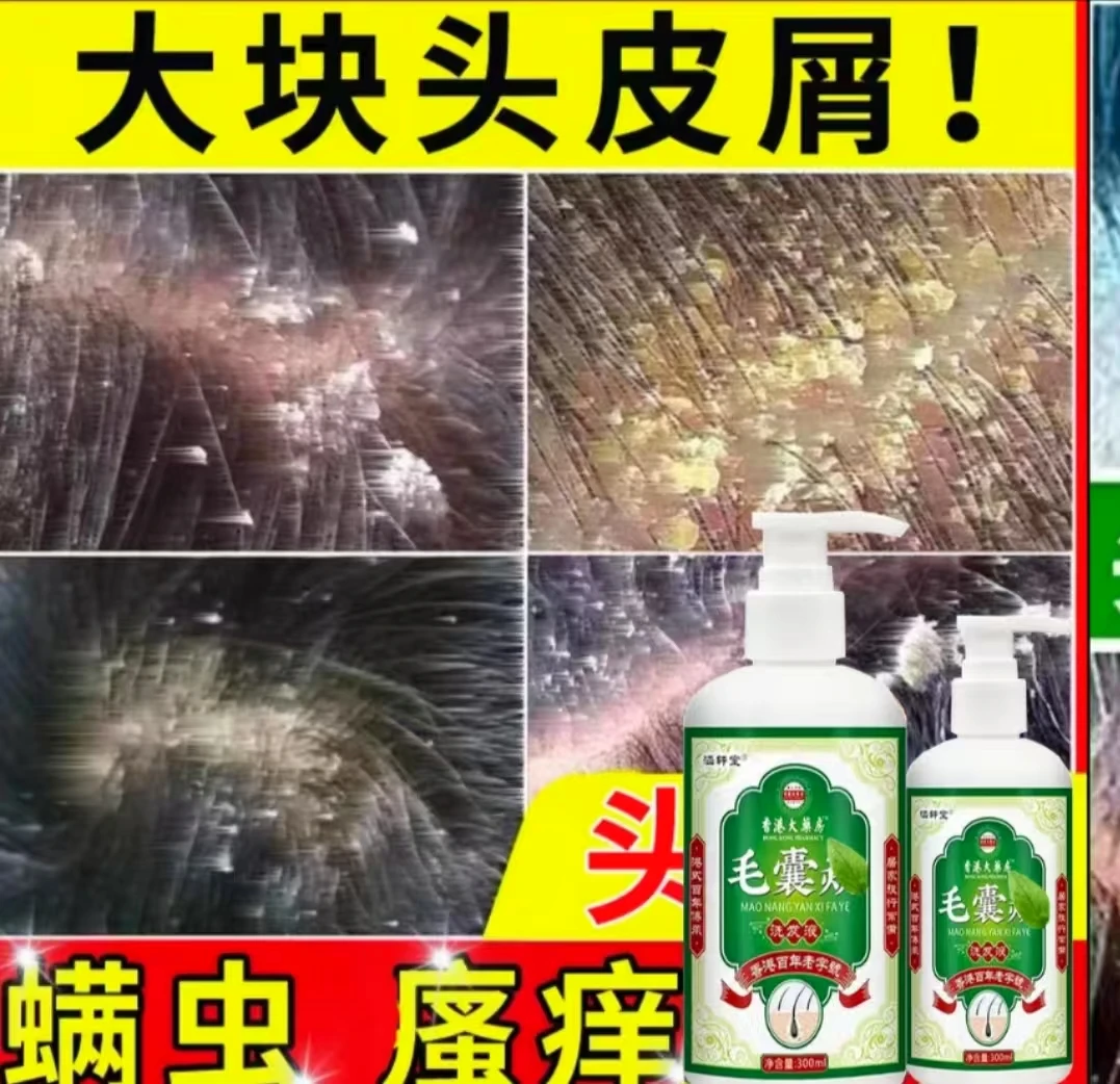 毛炎宁毛囊专用洗发水煤焦油洗剂头皮头部长红疙瘩痘痘去屑止痒