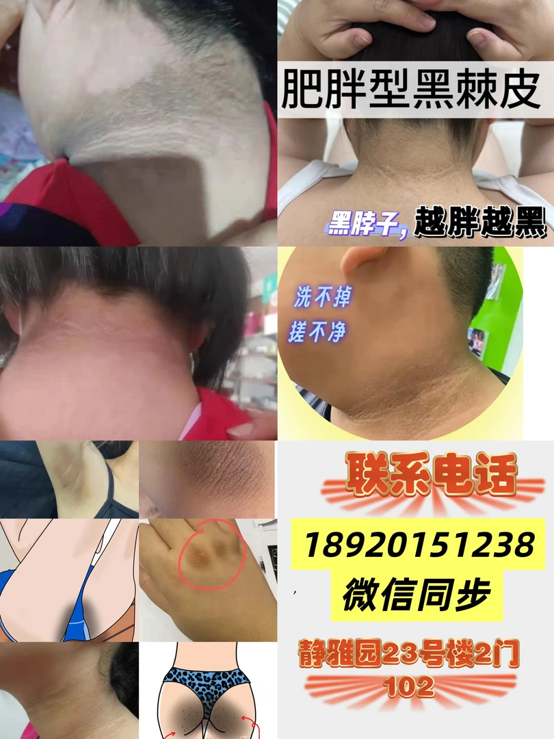 黑棘皮，黑色素沉着