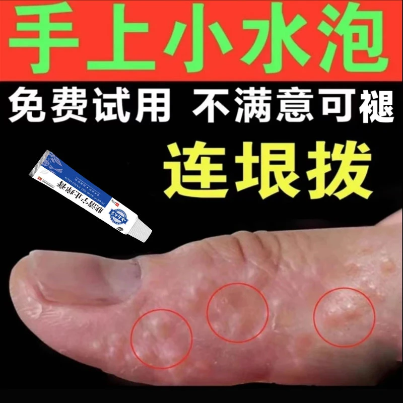 手指长小水泡手部痒手指开裂手指脱皮专用手足起汗泡抑菌软膏