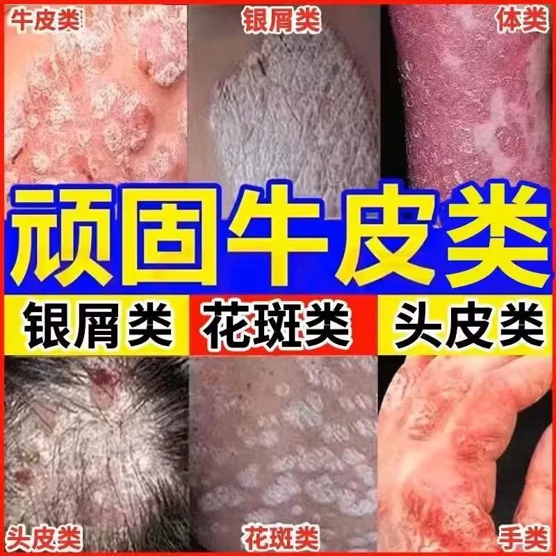 牛专用皮膏顽固王银止痒膏屑手足大腿内侧外用特效抑菌乳膏