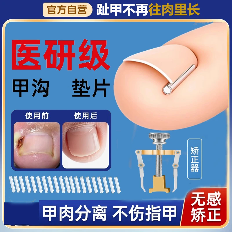 甲沟炎矫正神器指甲矫正器嵌甲专用纠正指甲扎肉往肉里长隔离垫片