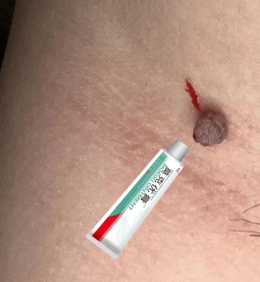 【无痕去脸上】正品小痦子膏去扁平肉刺去脖子丝状肉条小疙瘩去黑点