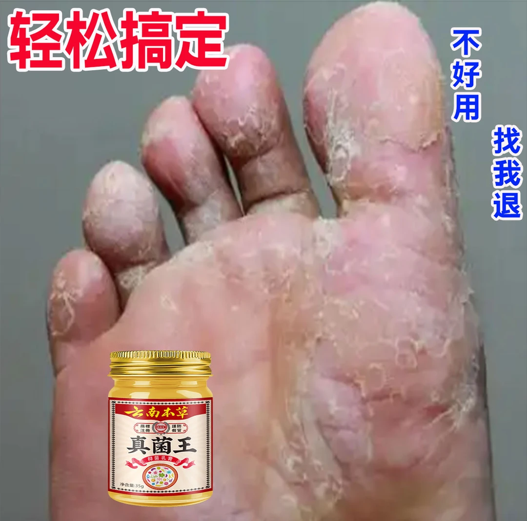 正品真菌王脚痒脚臭起小泡脚缝痒脱皮香港脚脚底痒抑菌外用止痒