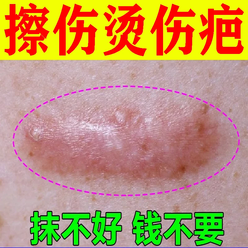 疤痕灵疙瘩胸前增生凹凸起软化修复膏去除去伤疤痕耳洞刀疤膏