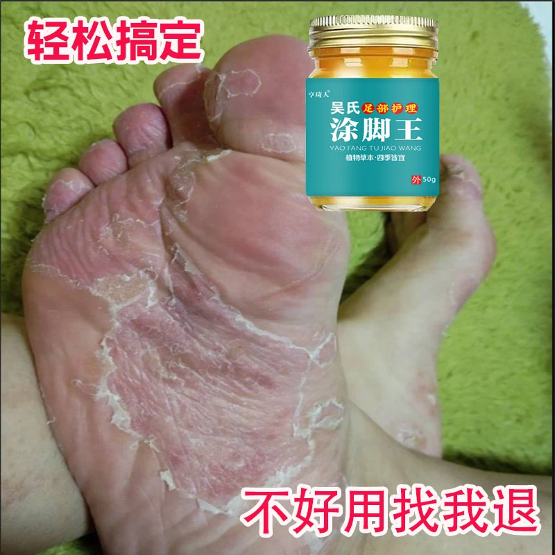 脚痒脚臭起水泡脚缝痒脱皮香港脚烂脚神器脱袜子脚底痒抑菌止痒