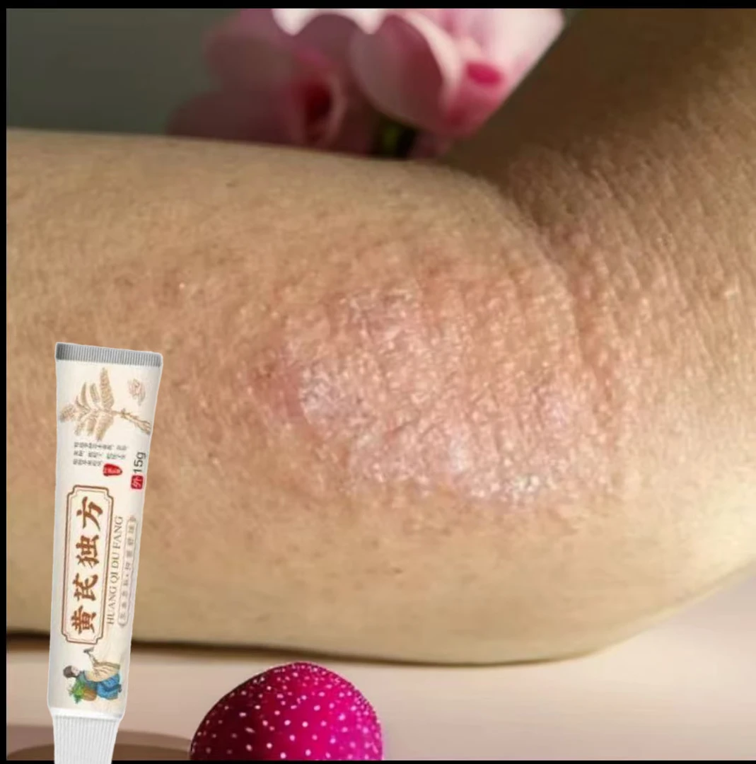 胳膊长红斑红点痘痘疙瘩皮肤日光性皮肤瘙痒小水泡红痒止痒涂抹膏