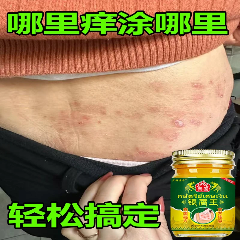 【泰国秘方】牛皮头藓银屑膏顽固手肤止痒大腿内侧全身可用止痒膏
