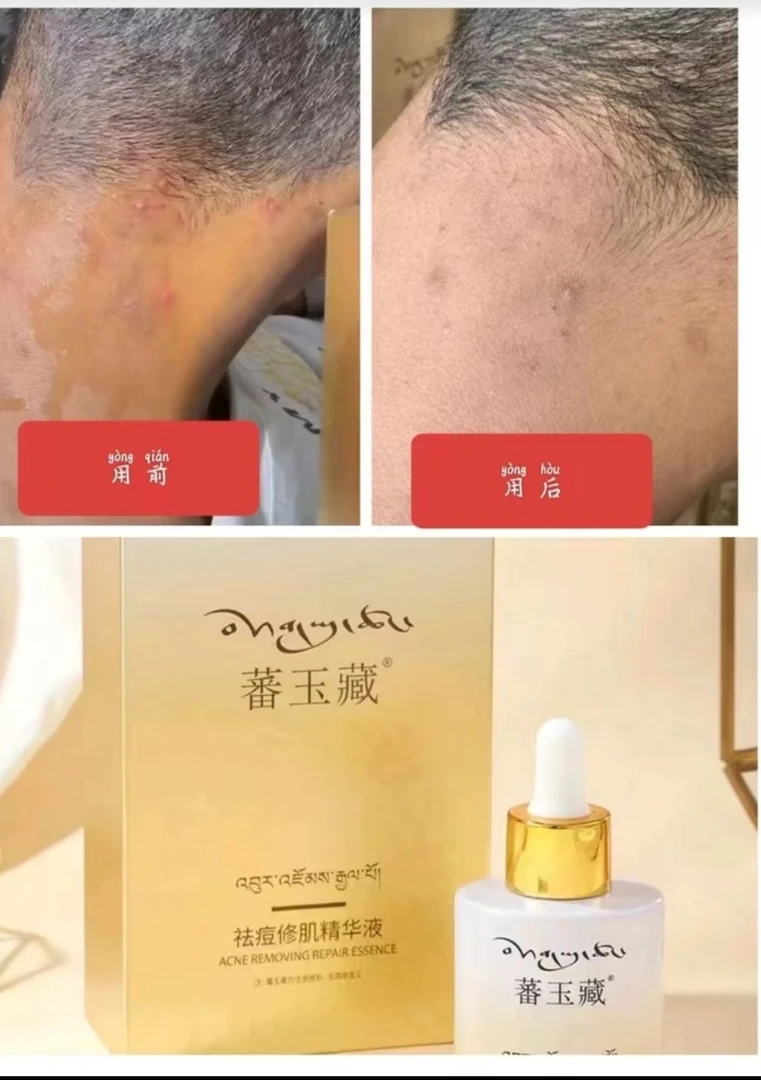 番玉藏祛痘修肌精华液