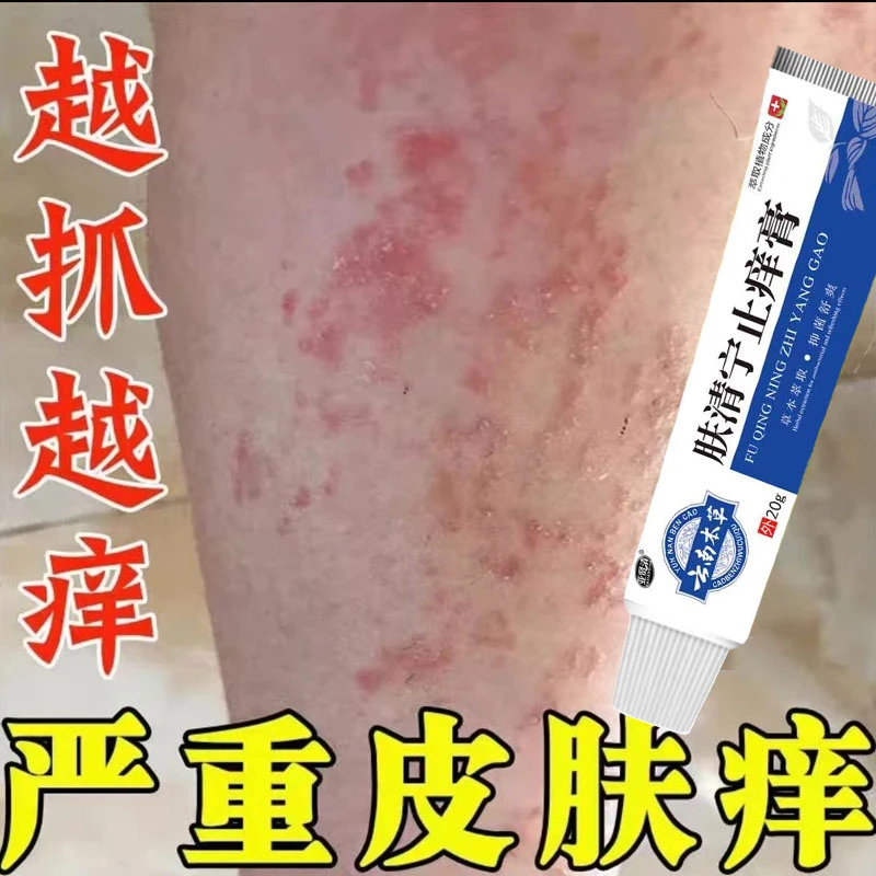 皮肤湿毒痒特效药干燥瘙痒湿痒止痒膏秋冬越抓越痒出血起红疙瘩