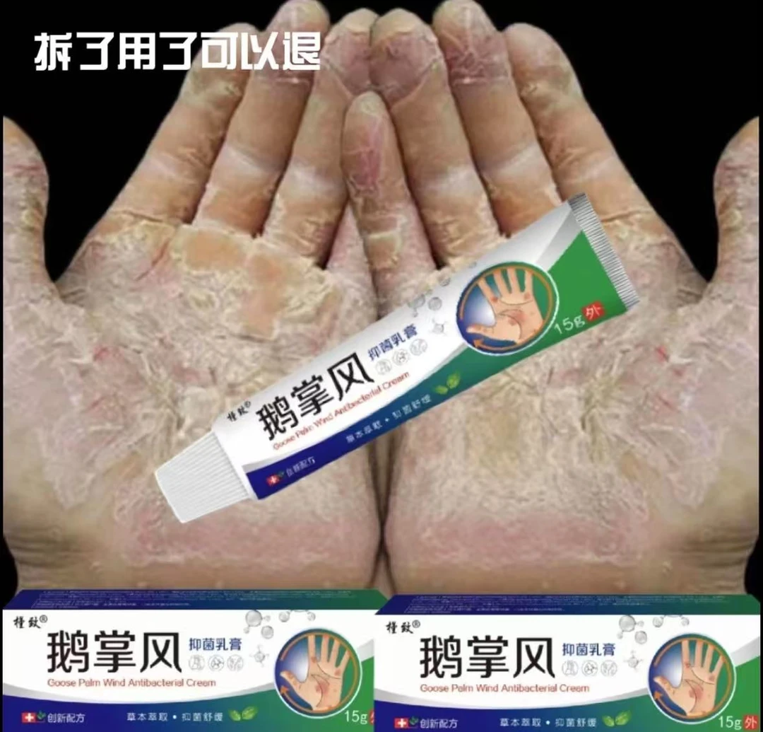 鹅掌风手部干裂脱皮手痒手裂口子手足起泡开口开裂起皮草本抑菌膏