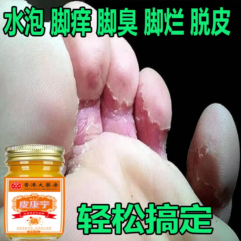 【正品皮康宁】脚痒脚臭起水泡脚缝痒脱皮香港脚脱脚底痒抑菌止痒