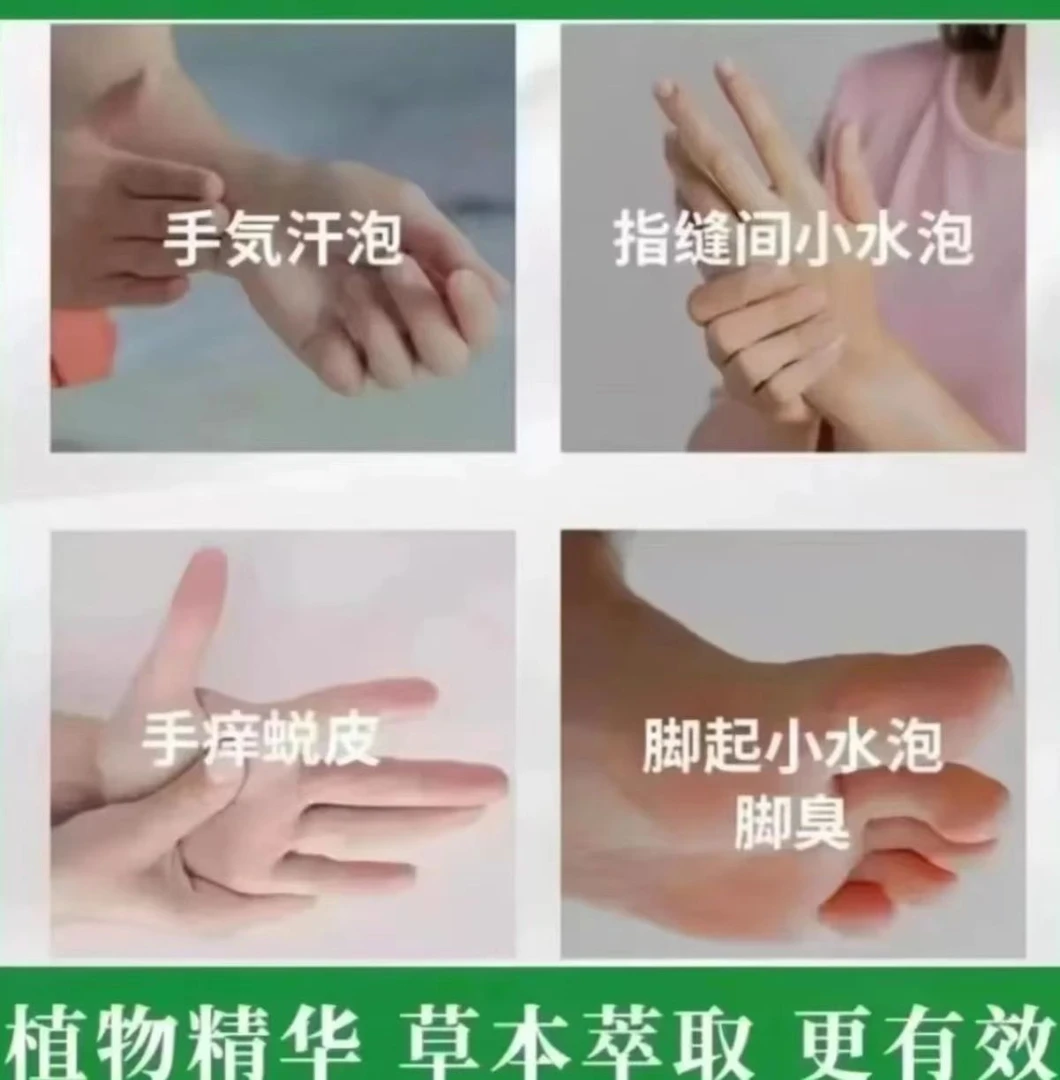 手上起 小水泡外用涂抹手指手缝红痒渗液脱皮止痒护理草本乳膏