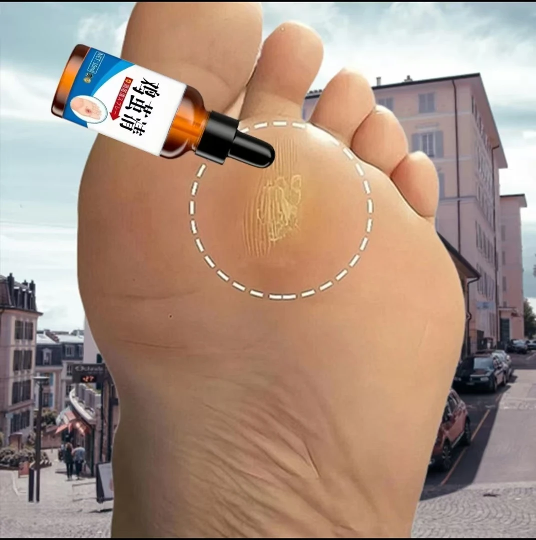 脚钉去除液去神器手脚上脚趾鸡厚皮茧脚底脚垫去脚上老茧软化剂