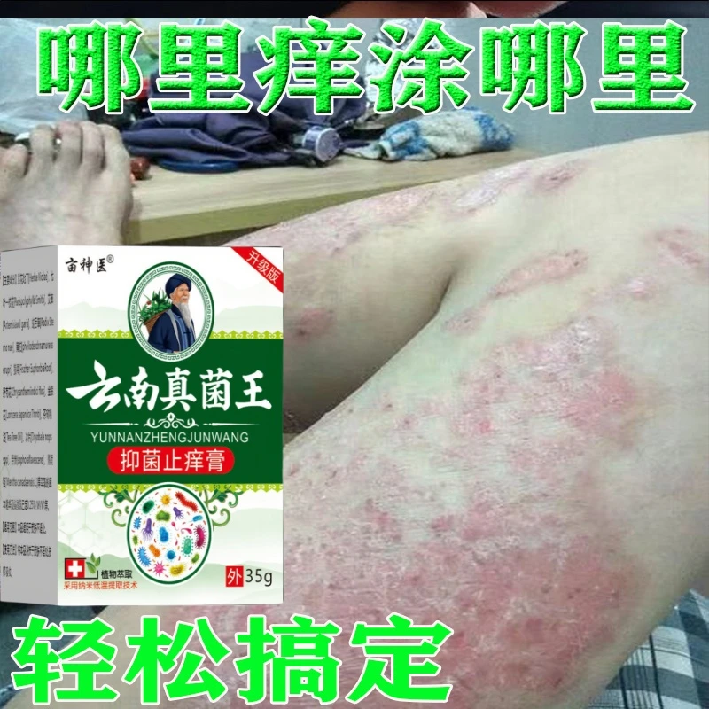 【正品真菌王】牛皮肤银屑膏头藓顽固手足股止痒大腿内侧痒全身可用