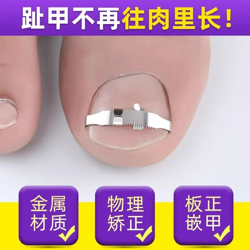 甲沟矫正器嵌甲贴片炎脚指甲往肉里长专用正甲扣纠正卷甲指甲神器