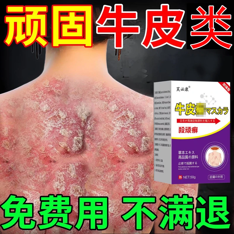 牛皮廯股痒膏大腿内侧骚痒止痒膏男女专用股沟缝潮湿痒真菌
