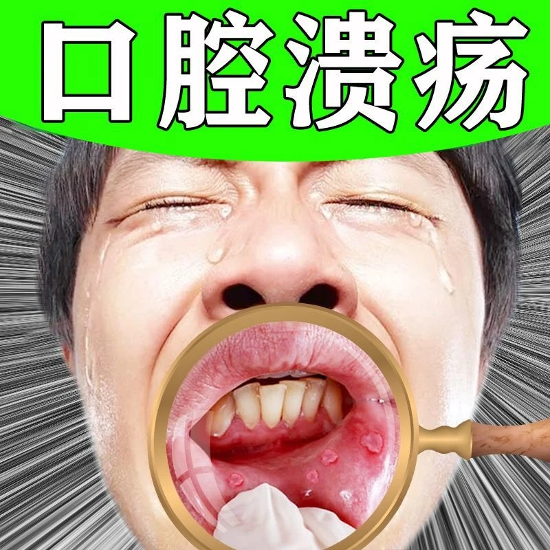 口腔溃疡云南本草嘴巴子舌头馈火起水泡清新草本护理抑菌缓解喷雾
