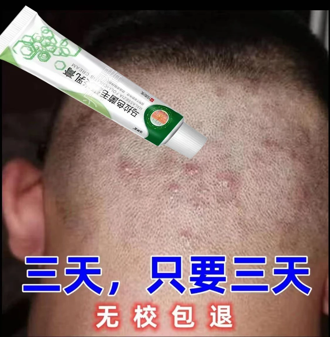 马拉色菌毛囊焱特性严重毛囊堵塞头上后脑勺前胸背部胸部痘痘乳膏