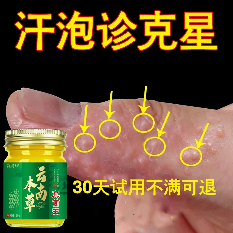 汗泡诊克星手上起小水泡止痒膏脱皮抑菌手指缝痒干裂专用草本乳膏