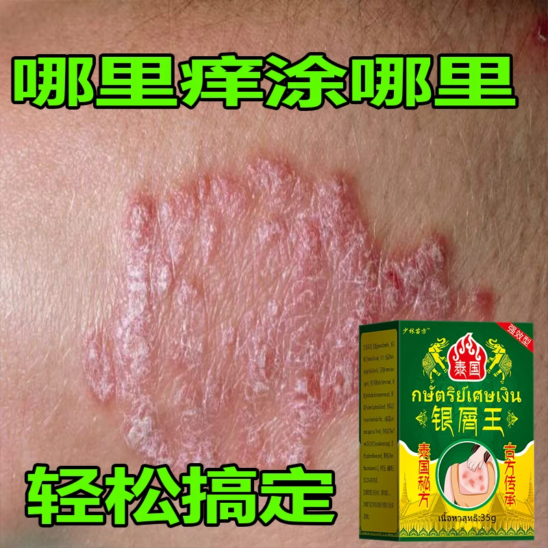 【泰国秘方】全身牛皮/银屑/手足头体股大腿内侧止痒软膏药专用肤癣