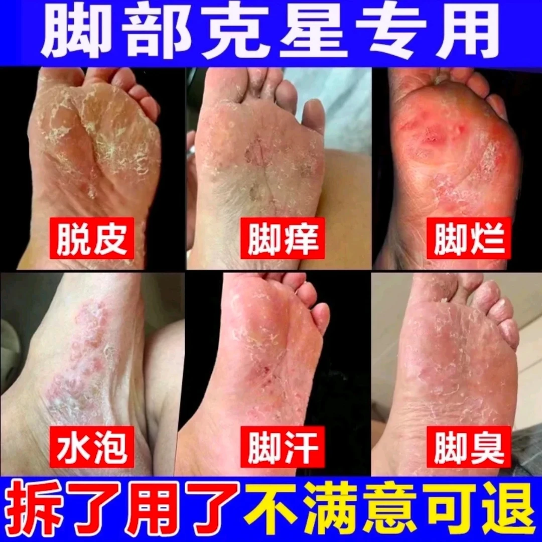 止痒膏祛脚出汗脱皮起水炮干裂脚趾缝痒抑菌止痒神器【足部护理】