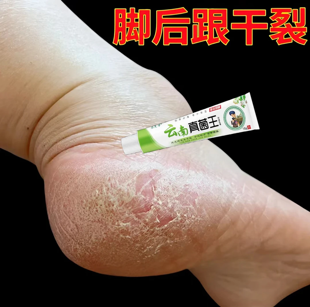 脚后跟干裂粗糙脚底起皮脚痒脚后跟脱皮脚臭抑菌止痒软膏