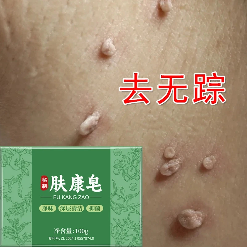 云医生秘制肤康皂手工去脖子手上腋下身上长肉粒无痛脱落改善男女