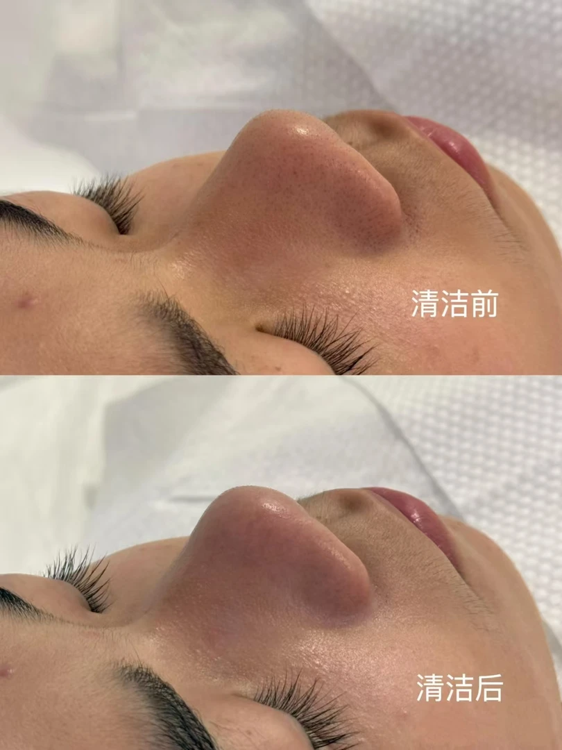 红痘痘熬夜痘闭口粉刺深度清洁